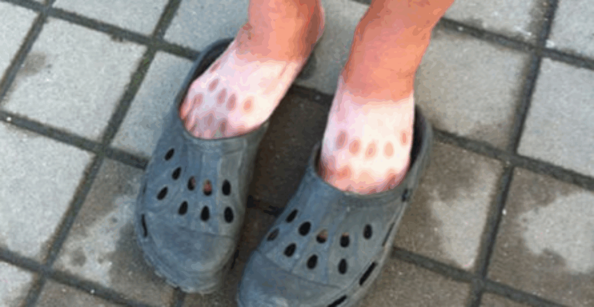 Käytätkö kesällä Crockseja? Tulos voi olla pian tämän näköinen