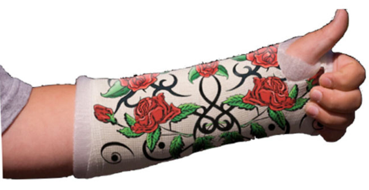 Näitä kipsejä kelpaa esitellä – luunmurtumat piiloon tyylikkäästi